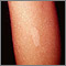 Tuberous sclerosis - hypopigmented macule Tuberous sclerosis - hypopigmented macule