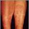 Granuloma annulare on the legs Granuloma annulare on the legs