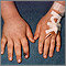 Snake bite on the finger Snake bite on the finger