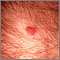 Kaposi sarcoma - perianal Kaposi sarcoma - perianal