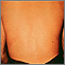 Strongyloidiasis, creeping eruption on the back Strongyloidiasis, creeping eruption on the back