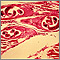 Trichinella spiralis in human muscle Trichinella spiralis in human muscle
