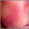 Keratosis pilaris rubra faceii Keratosis pilaris rubra faceii