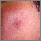 Fixed drug eruption on the cheek Fixed drug eruption on the cheek