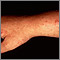 Polymorphic light eruption on the arm Polymorphic light eruption on the arm