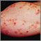Dermatitis herpetiformis on the forearm Dermatitis herpetiformis on the forearm