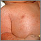 Miliaria crystallina - chest and arm Miliaria crystallina - chest and arm