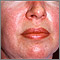 Dermatomyositis - heliotrope rash on the face Dermatomyositis - heliotrope rash on the face
