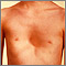Pectus excavatum Pectus excavatum