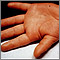 Kawasaki disease - edema of the hand Kawasaki disease - edema of the hand