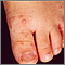 Hand, foot, and mouth disease on the foot Hand, foot, and mouth disease on the foot