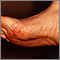 Cholesterol emboli Livedo Reticularis - feet Cholesterol emboli Livedo Reticularis - feet