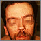 Basal cell nevus syndrome - face Basal cell nevus syndrome - face