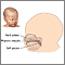 Cleft lip repair - series Cleft lip repair - series