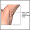 Swollen lymph nodes under arm Swollen lymph nodes under arm