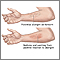 Positive reaction to allergen Positive reaction to allergen