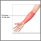 Cellulitis on the arm Cellulitis on the arm