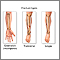 Fracture types (2) Fracture types (2)