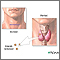 Parathyroidectomy Parathyroidectomy
