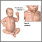 Fractured clavicle (infant) Fractured clavicle (infant)