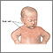Infant heat rash Infant heat rash