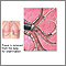 Bronchoscopic culture Bronchoscopic culture