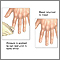Nail blanch test Nail blanch test