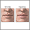 Chapped lips Chapped lips