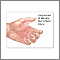 Contracture deformity Contracture deformity