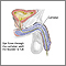 Cystography Cystography