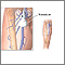 Doppler ultrasonography of an extremity Doppler ultrasonography of an extremity