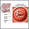 Pap smears and cervical cancer Pap smears and cervical cancer