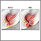 Imperforate anus Imperforate anus