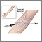 Intravenous pyelogram Intravenous pyelogram