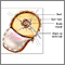 Craniotomy for cerebral shunt Craniotomy for cerebral shunt