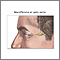 Neurofibroma Neurofibroma