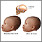Newborn head molding Newborn head molding