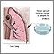 Pleural culture