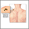 Melanoma