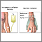 Radiation therapy Radiation therapy