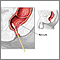 Rectal culture Rectal culture