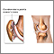 Runners knee