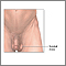 Scrotal mass Scrotal mass