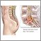 Spinal stenosis Spinal stenosis