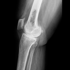Bone Cancer