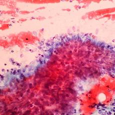 Cervical Cancer
