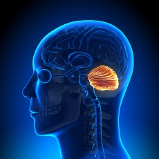 Chiari Malformation