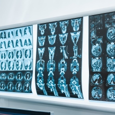 Encephalitis