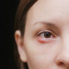 Eye Infections