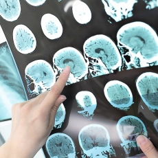Hemorrhagic Stroke